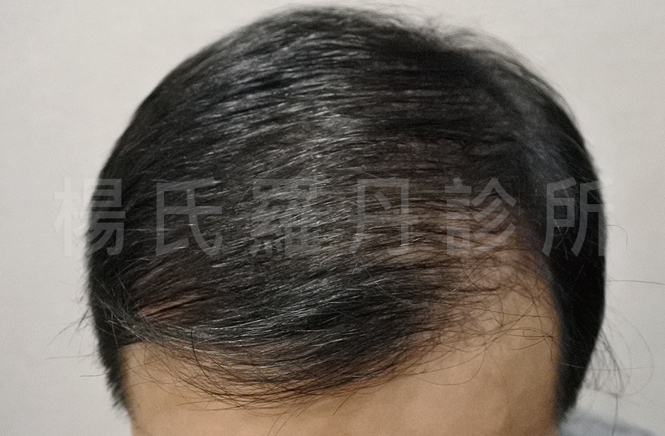 植髮效果 禿頭 落髮