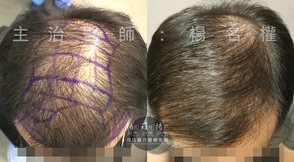 植髮手術 植髮 禿頭