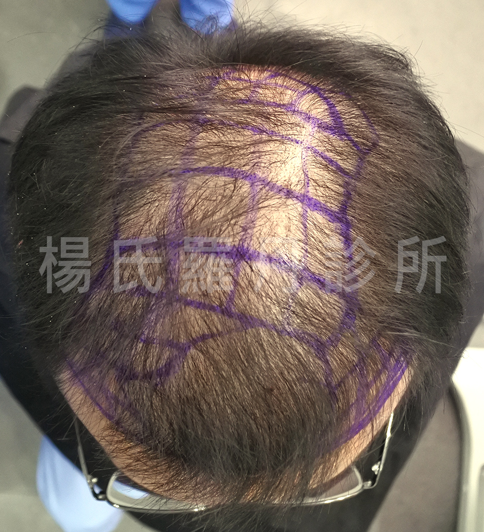 禿頭 落髮 植髮效果 植髮