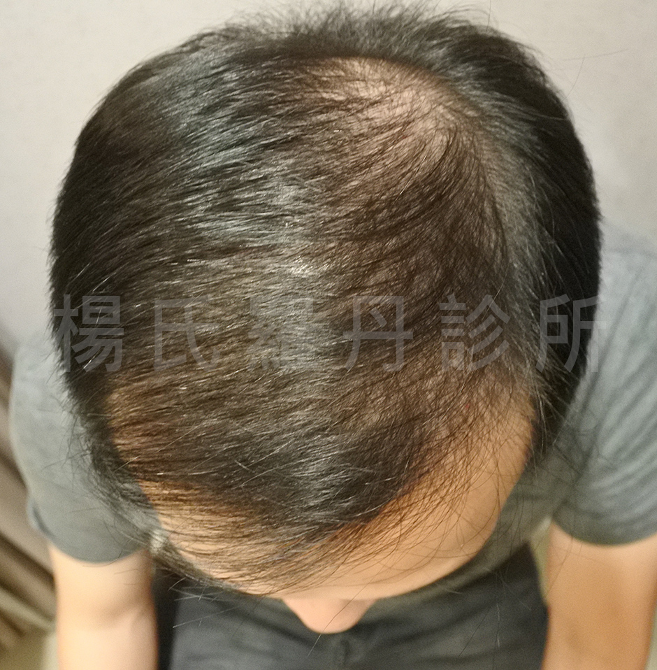 落髮 植髮效果 植髮