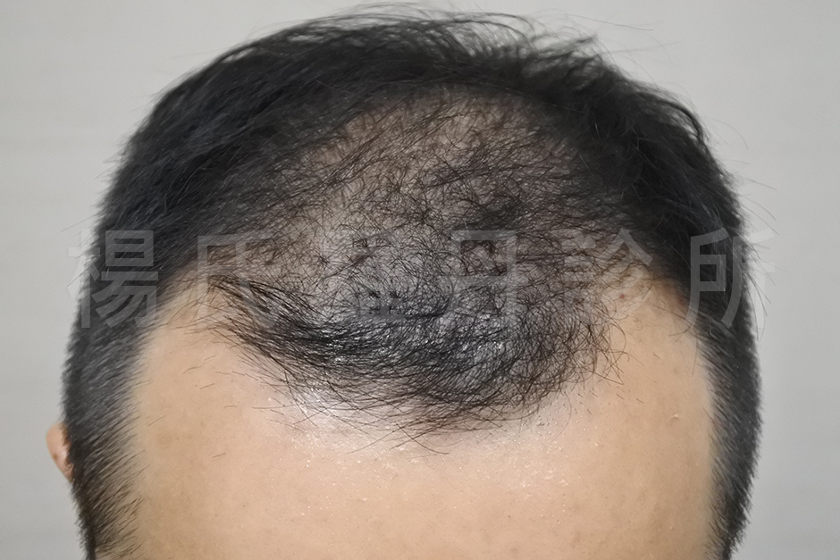 植髮手術 禿頭 落髮