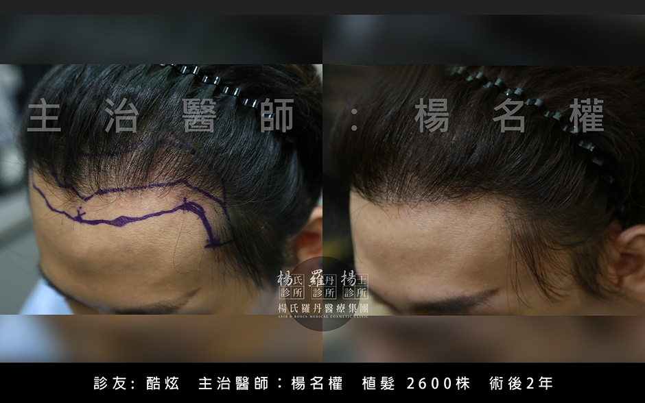 禿頭