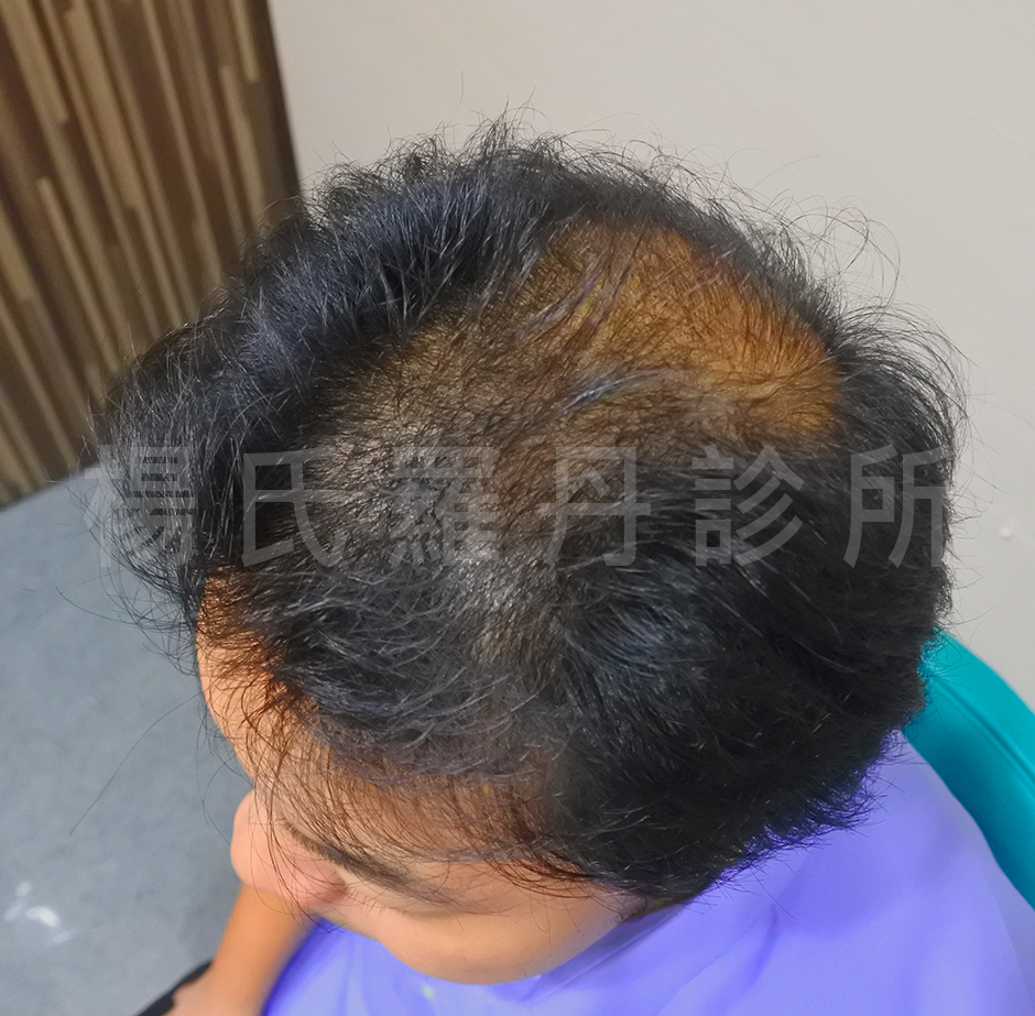 雄性禿  植髮手術  掉髮