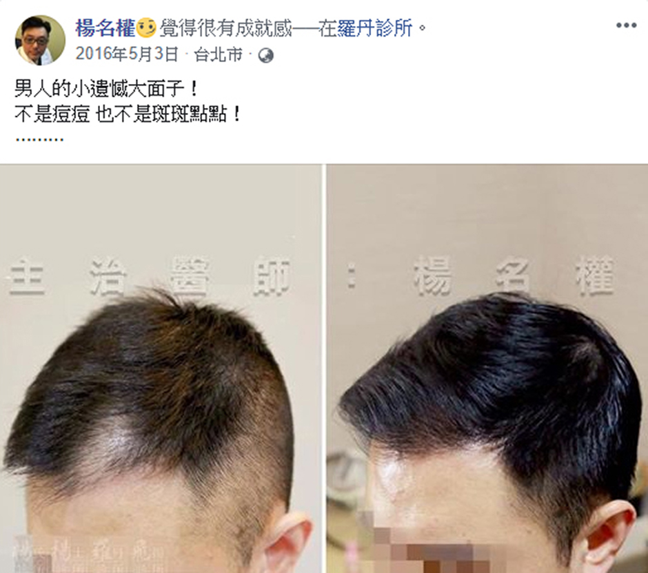 民雄,禿頭,地中海禿,楊氏羅丹,植髮