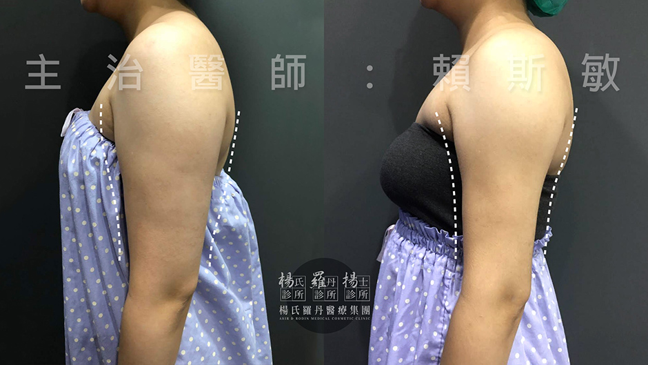 瘦手臂 手臂 贅肉 雷射減脂