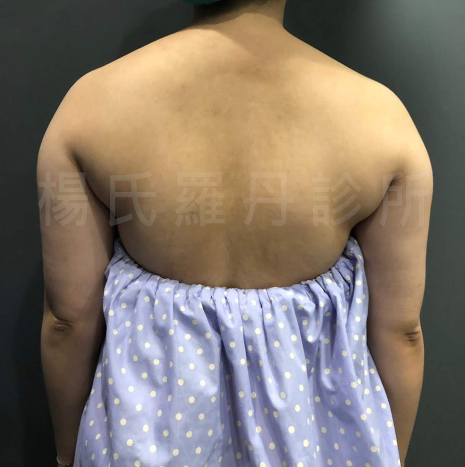 贅肉  手臂 瘦手臂 雷射減脂