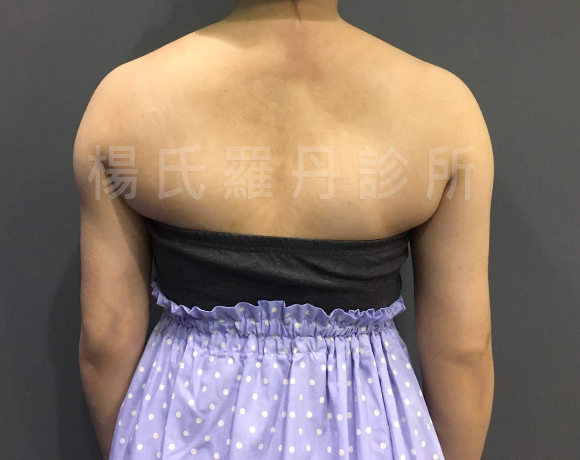 手臂 贅肉 掰掰袖   雷射減脂