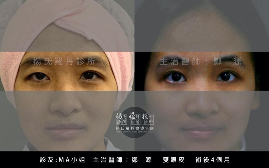 縫雙眼皮