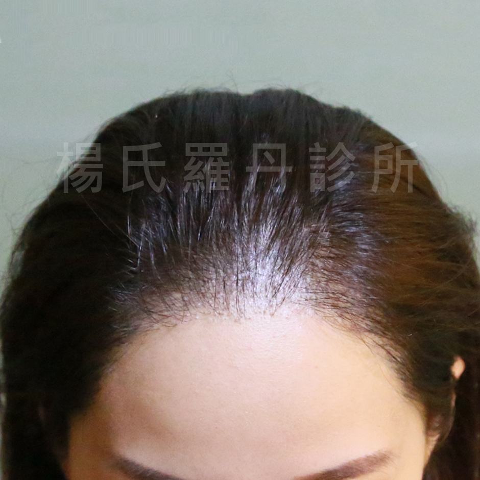 髮際線