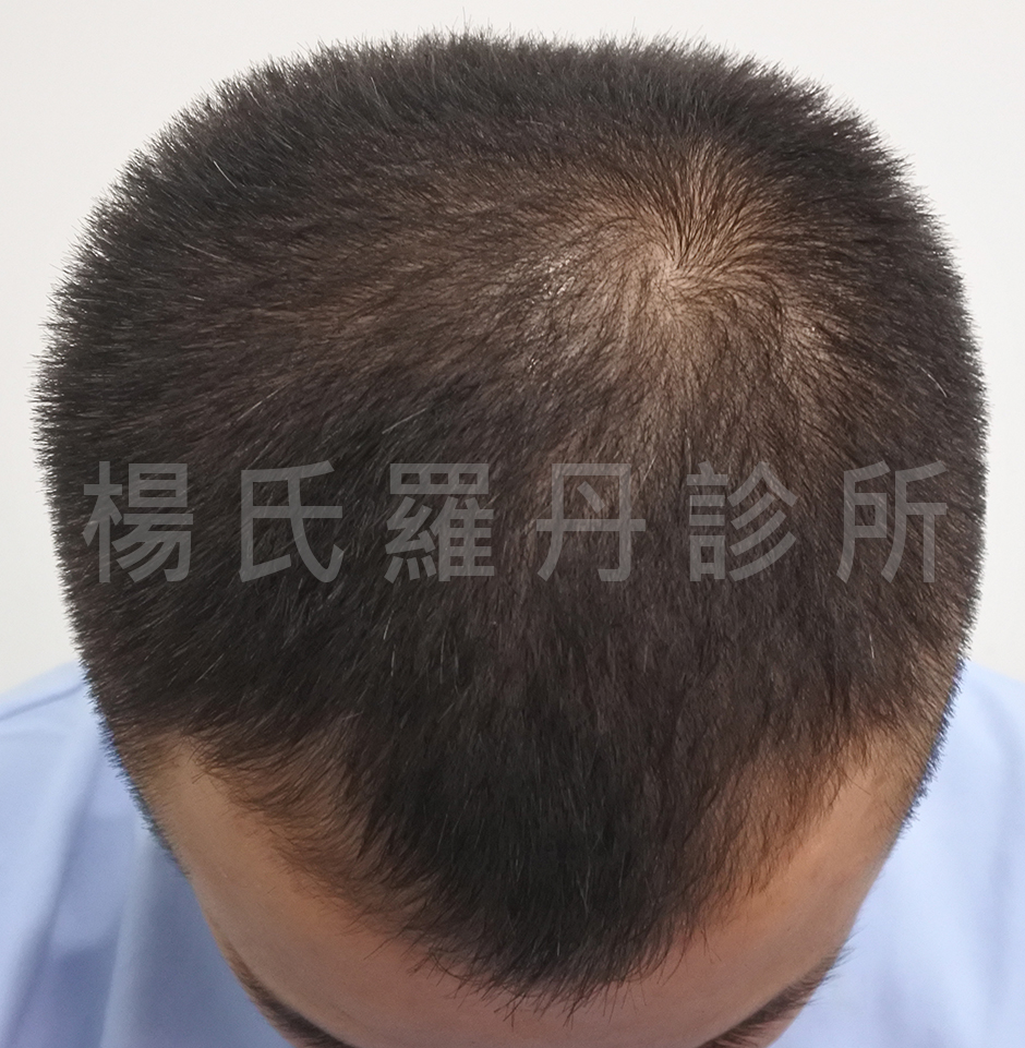 植髮 禿頭 雄性禿 落髮 生髮