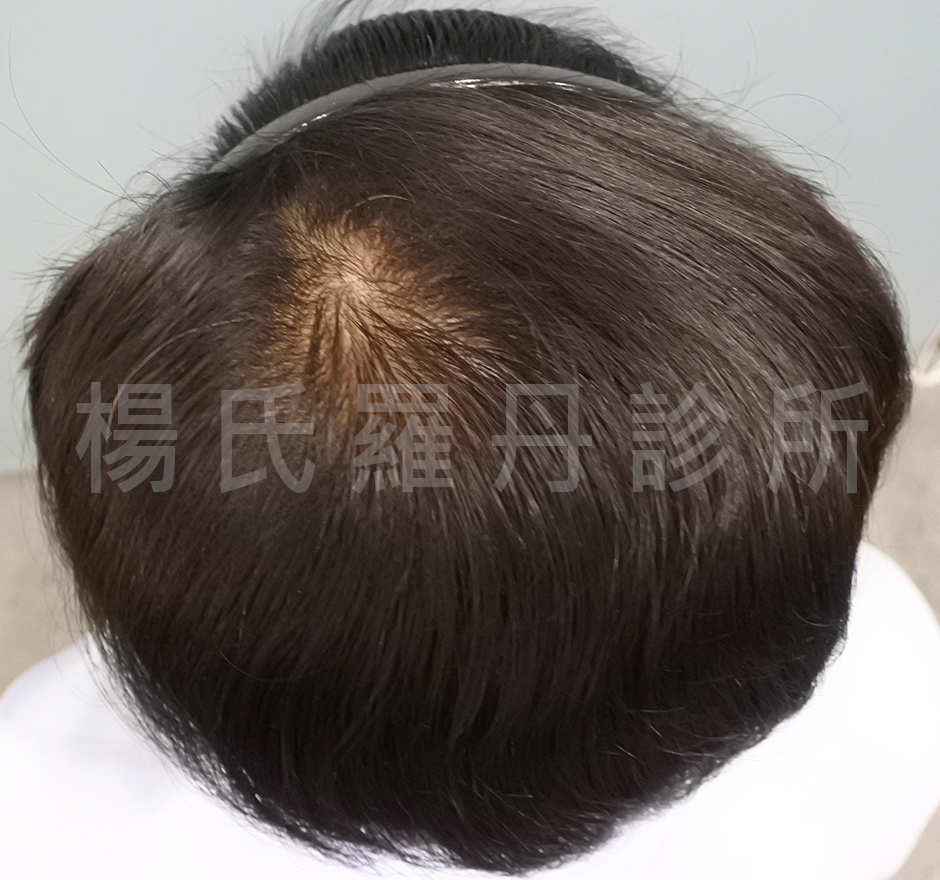 植髮  禿頭  落髮 生髮 ARTAS