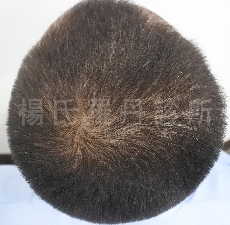 禿頭 植髮 落髮 ARTAS 植髮診所