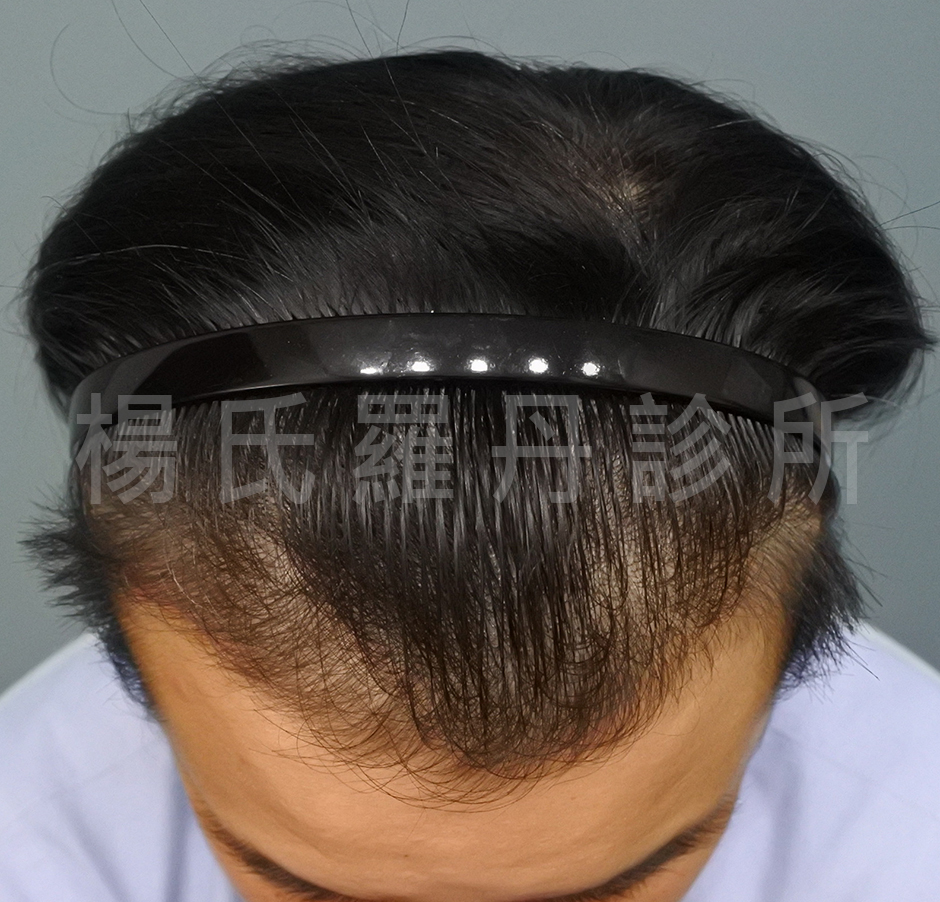 落髮 禿頭 植髮 植髮手術 ARTAS