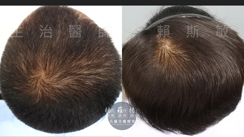 雄性禿 植髮 落髮 禿頭 ARTAS