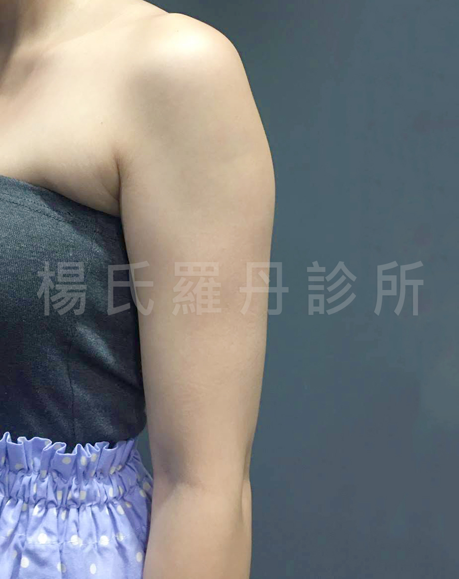手臂 贅肉 雷射減脂 瘦手臂