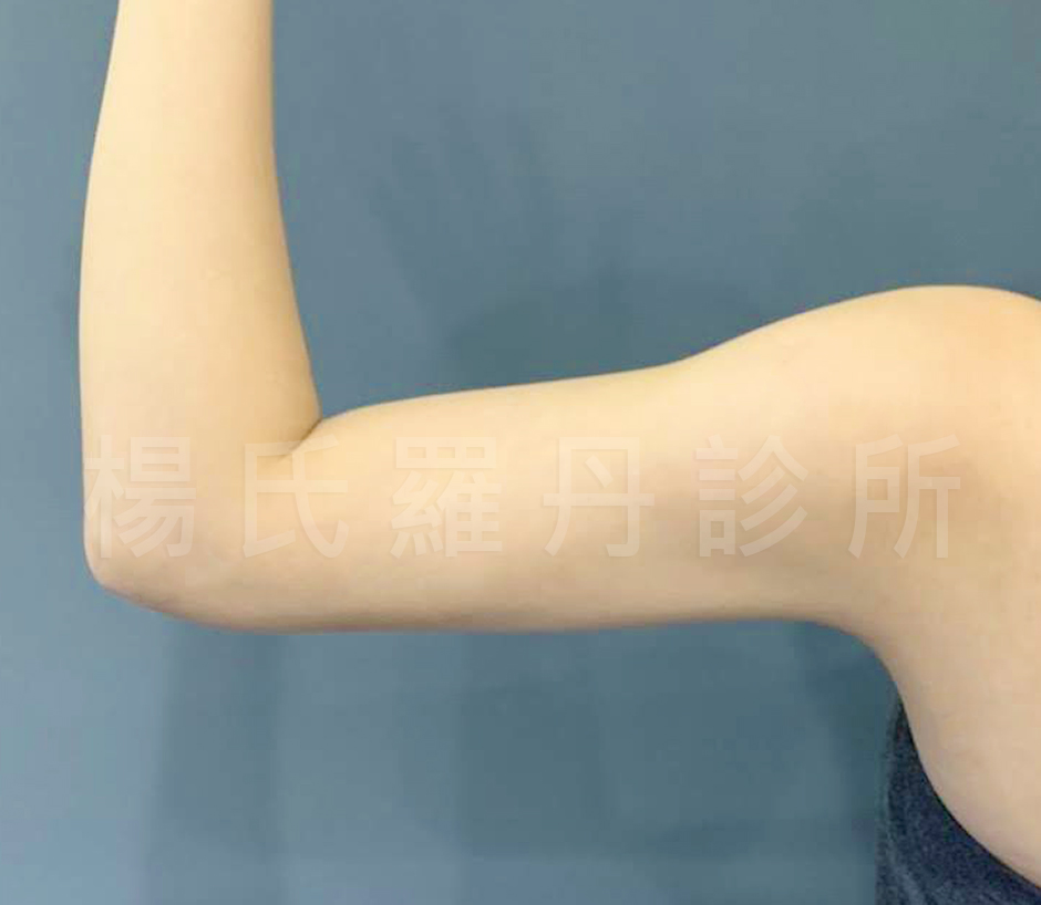 雷射減脂 手臂 手臂線條 瘦手臂