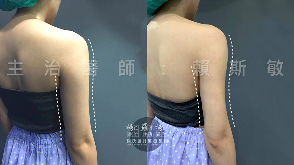 贅肉 手臂 瘦手臂 雷射減脂 手臂線條