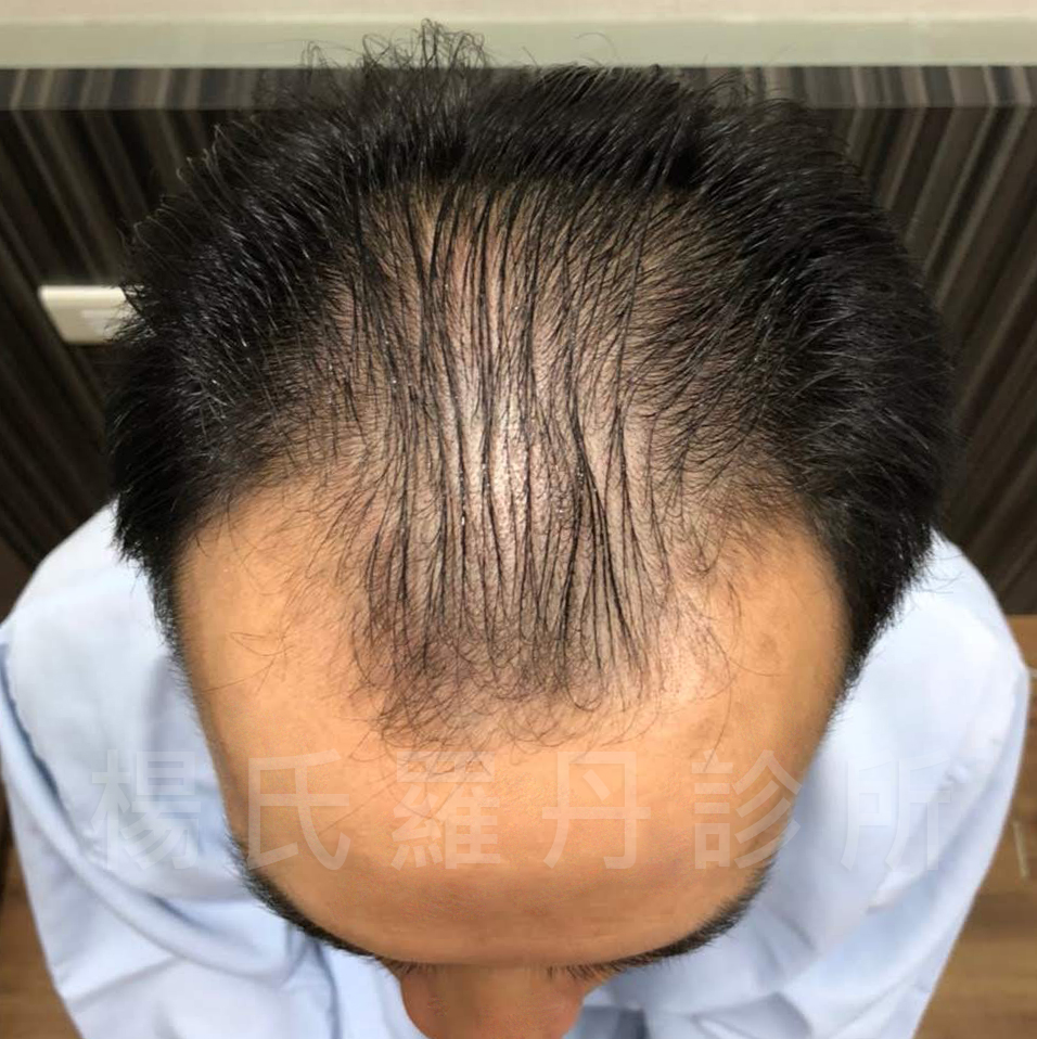 禿頭