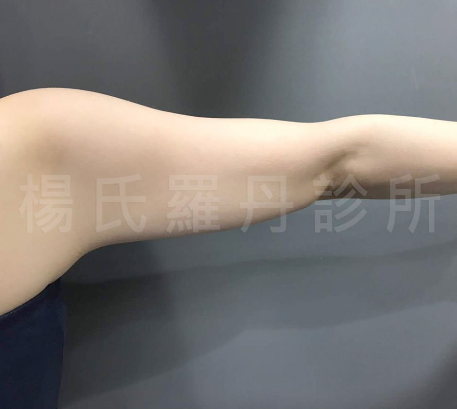手臂 瘦手臂 雷射減脂 贅肉 抽脂
