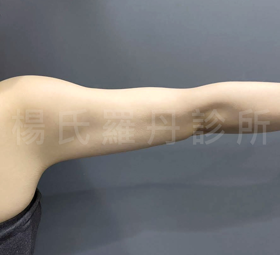 掰掰袖 贅肉 瘦手臂 雷射減脂