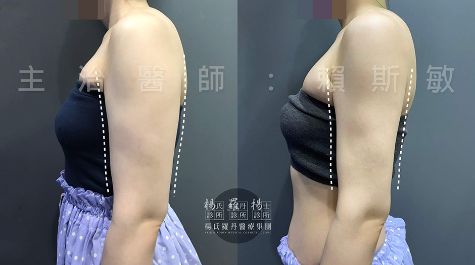 雷射減脂 手臂  瘦手臂 掰掰袖