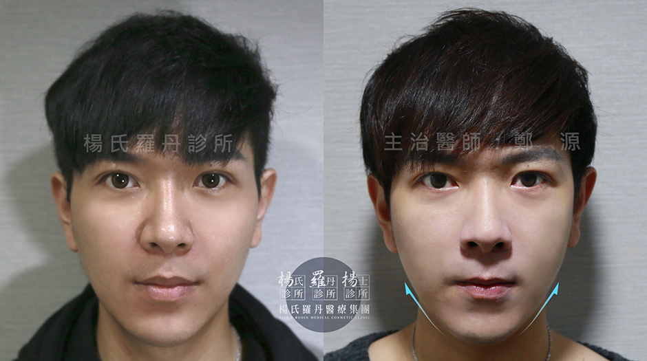 Ulthera極線音波  飛梭雷射 醫學美容 音波拉提