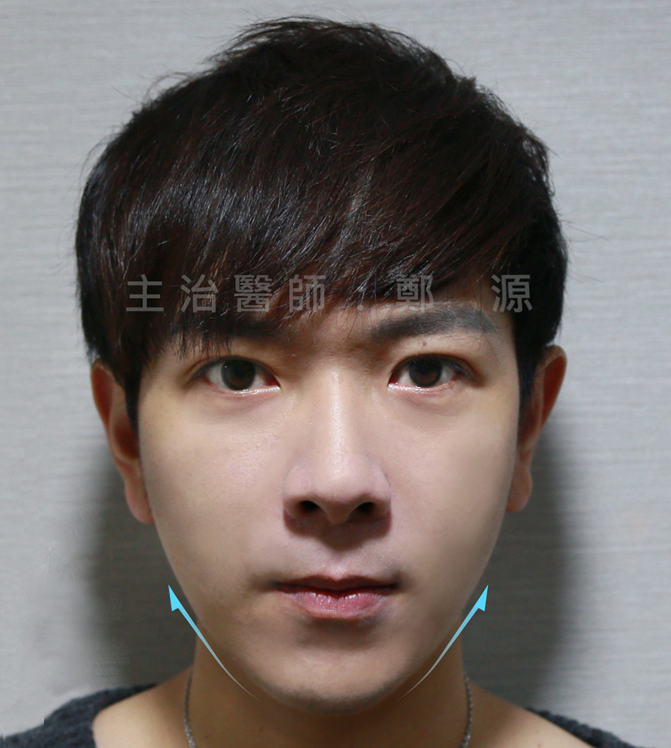 飛梭雷射 楊氏羅丹 醫學美容 音波拉提