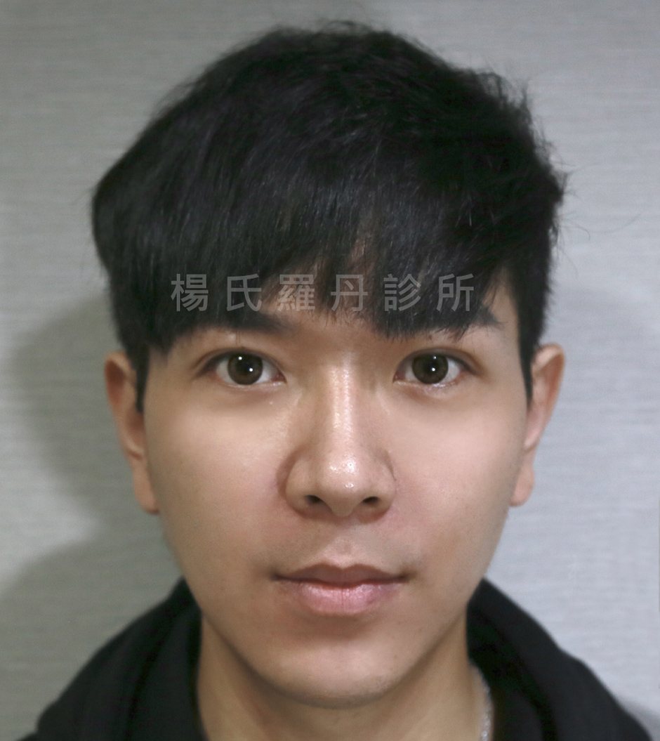 馬克 飛梭雷射 醫學美容 音波拉提