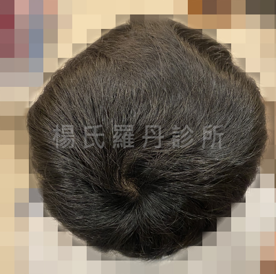 生髮 生髮613 六合一三階段雄性禿治療