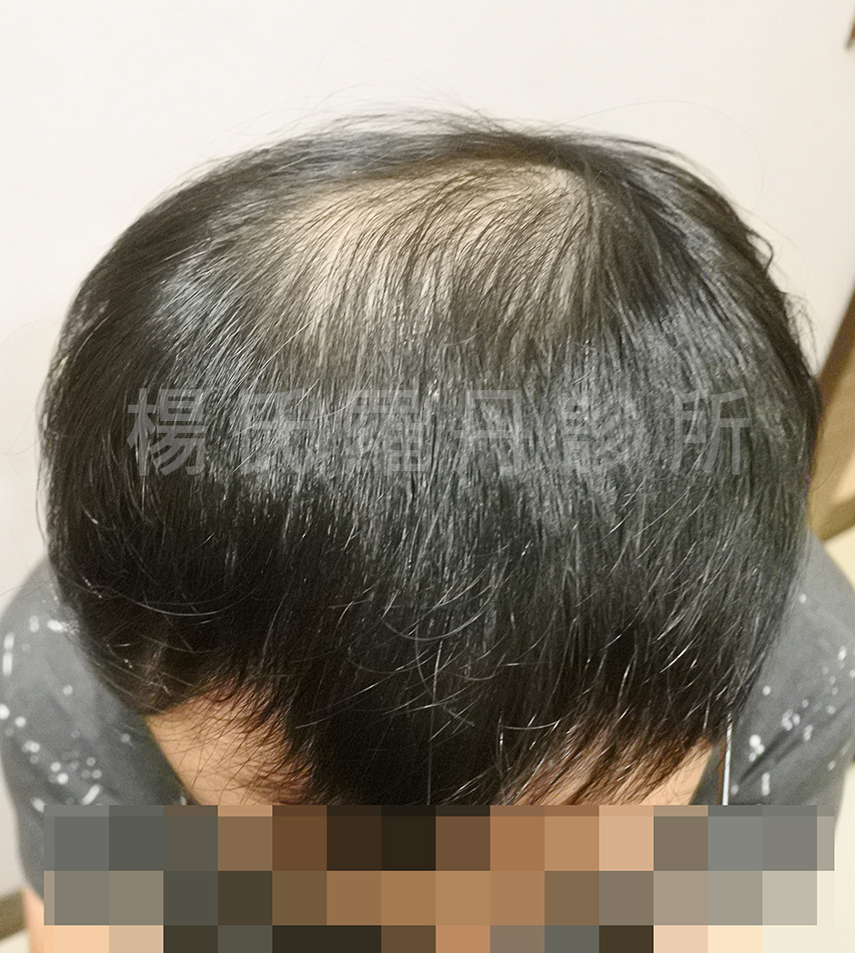 生髮療程 六合一三階段雄性禿治療 生髮613