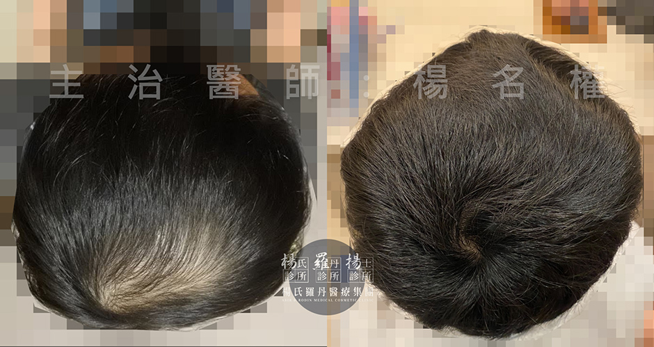 生髮613 六合一三階段雄性禿治療 生髮療程