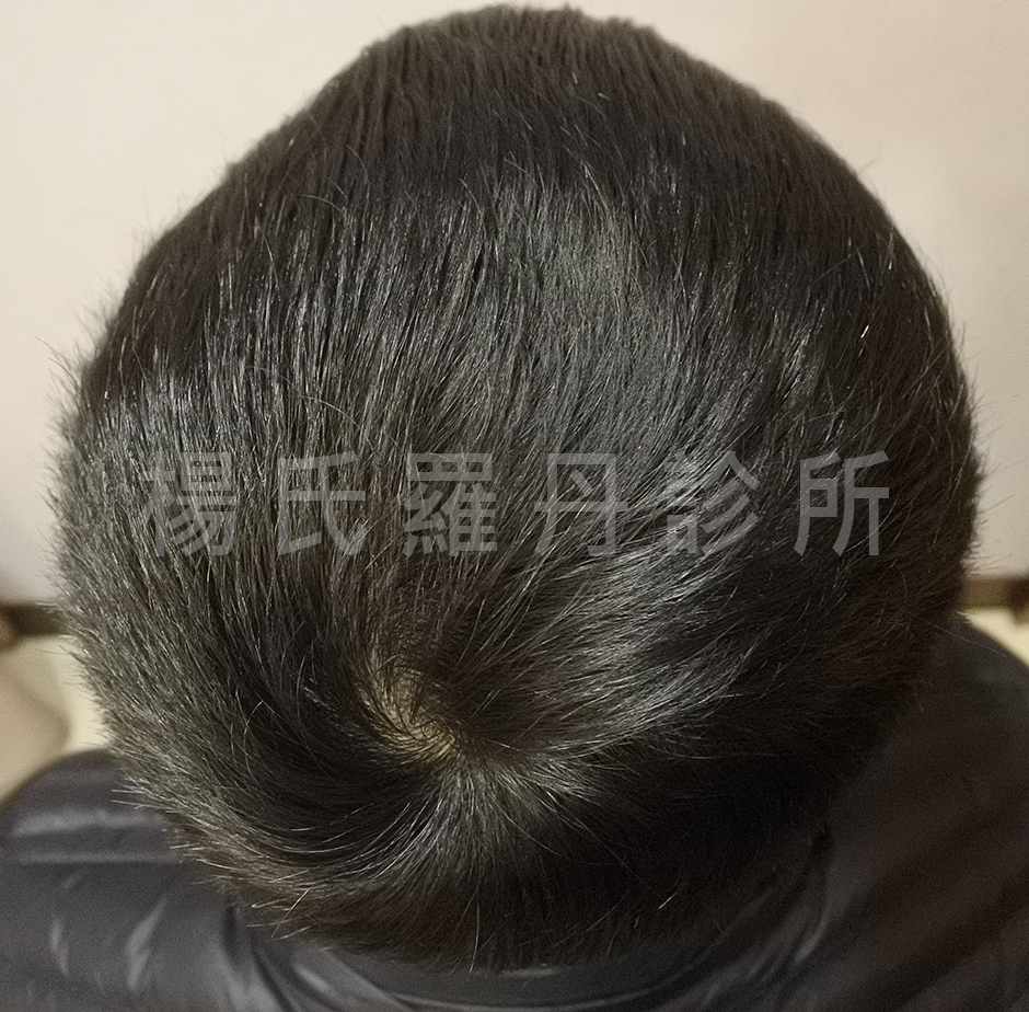 非手術生髮療程 生髮613 六合一三階段雄性禿治療