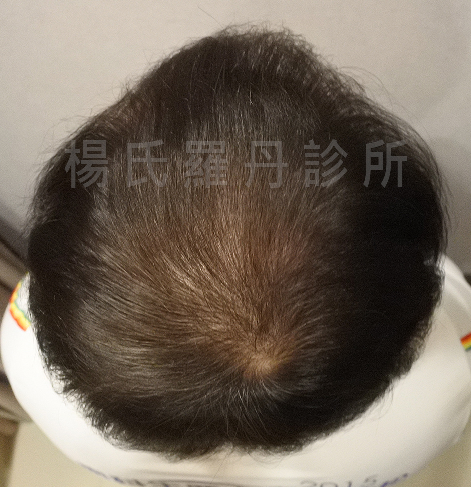 植髮