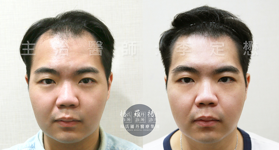 植髮，楊氏羅丹