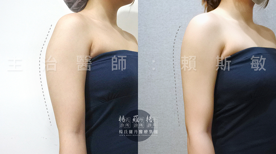 抽脂,瘦手臂,雷射減脂,贅肉