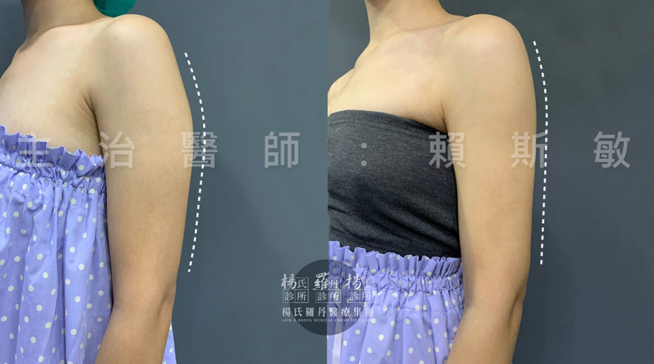 楊氏羅丹,瘦手臂,雷射減脂,賴斯敏