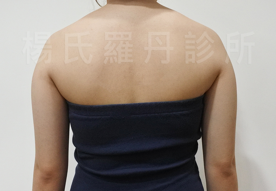 蝴蝶袖,抽脂,瘦手臂