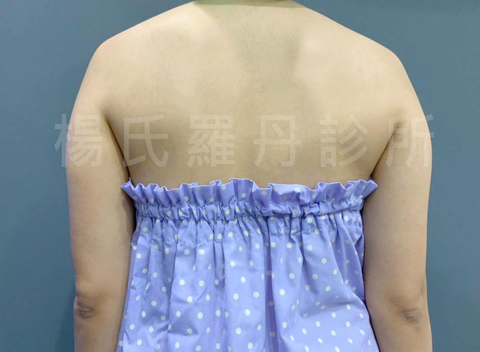 雷射減脂,蝴蝶袖,手臂,楊氏羅丹,賴斯敏