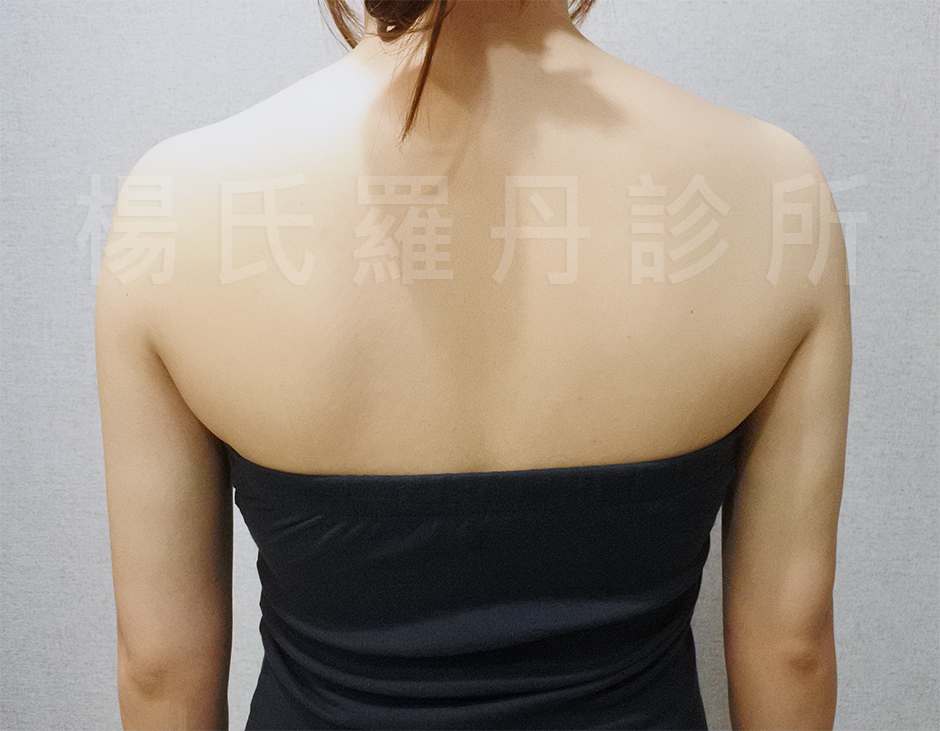 雷射減脂,瘦手臂,抽脂