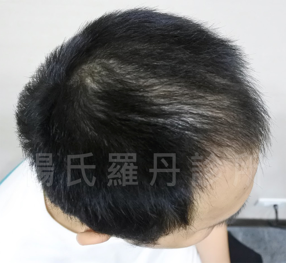 禿頭,掉髮,M字型禿