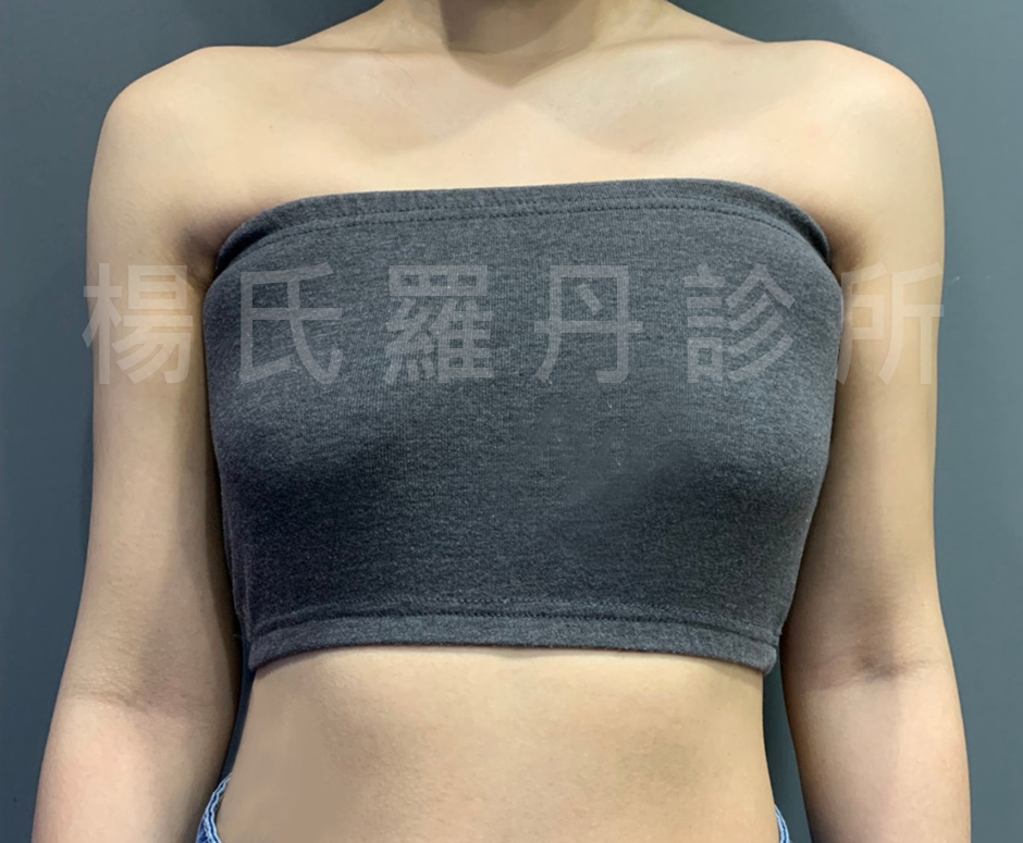 瘦手臂 雷射減脂  手臂