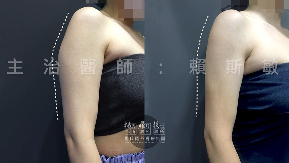 手臂,雷射減脂,瘦手臂,贅肉