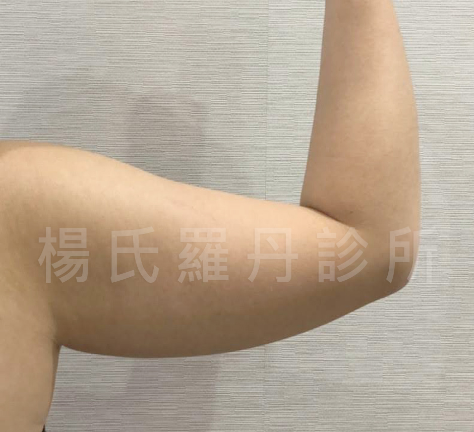 贅肉,手臂,雷射減脂