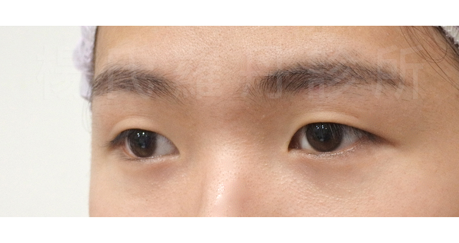 單眼皮,雙眼皮,楊氏羅丹