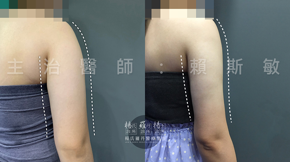 手臂,蝴蝶袖,贅肉 瘦手臂 