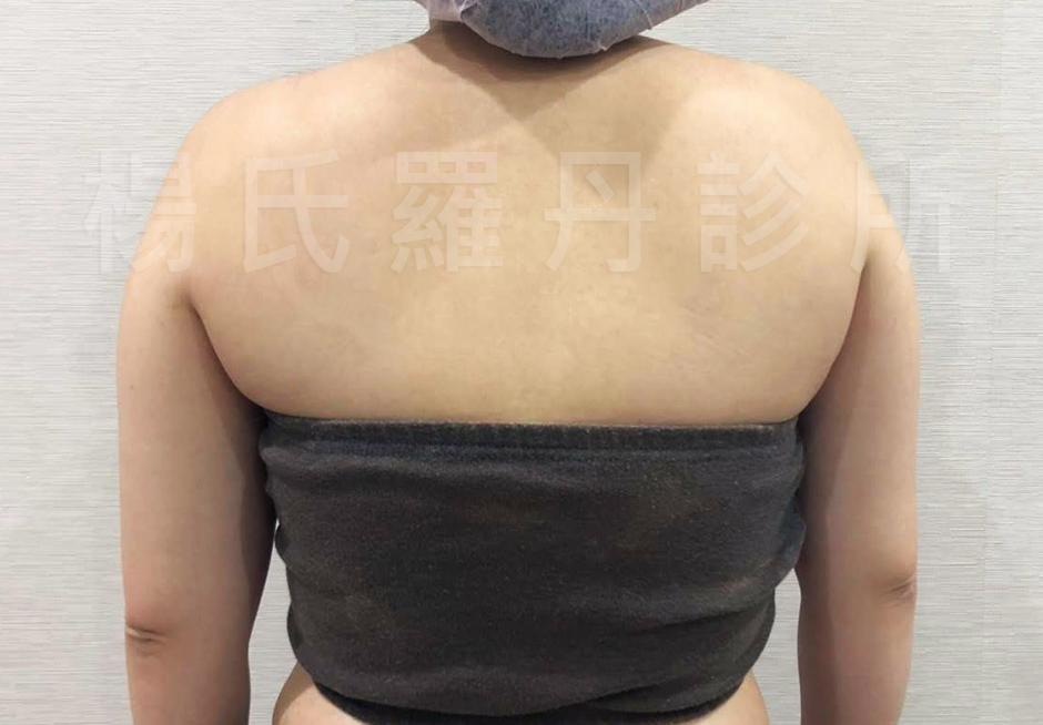 手臂,雷射減脂, 瘦手臂