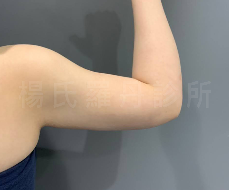 楊氏羅丹,瘦手臂,雷射減脂,手臂 贅肉