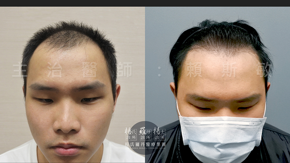 植髮,掉髮,禿頭,雄性禿