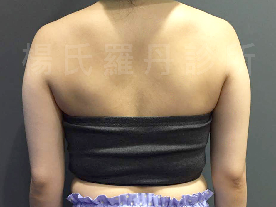 雷射減脂,楊氏羅丹,瘦手臂,手臂 贅肉