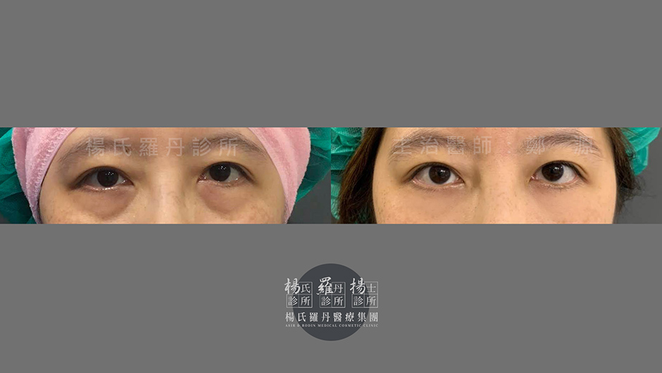 眼袋,淚溝,自體脂肪